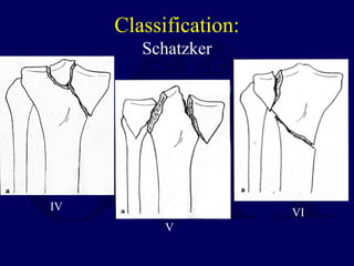 Classification:
Schatzker
IV
V
VI
 