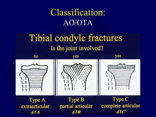 Classification:
AO/OTA
 