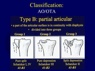 Classification:
AO/OTA
 