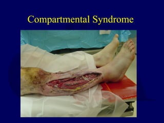 Compartmental Syndrome
 