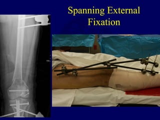 Spanning External
Fixation
 