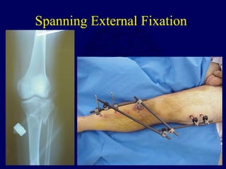 Spanning External Fixation
 