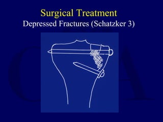 Surgical Treatment
Depressed Fractures (Schatzker 3)
 