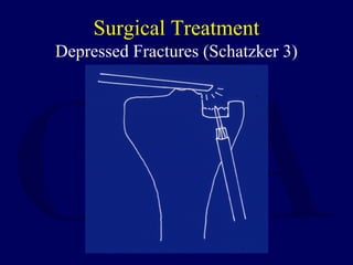 Surgical Treatment
Depressed Fractures (Schatzker 3)
 