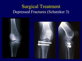 Surgical Treatment
Depressed Fractures (Schatzker 3)
 