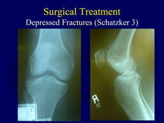 Surgical Treatment
Depressed Fractures (Schatzker 3)
 