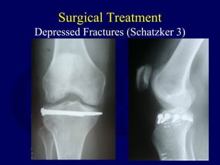 Surgical Treatment
Depressed Fractures (Schatzker 3)
 