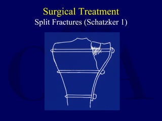 Surgical Treatment
Split Fractures (Schatzker 1)
 