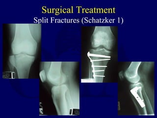 Surgical Treatment
Split Fractures (Schatzker 1)
 