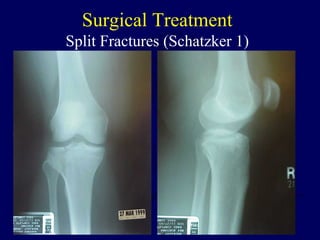 Surgical Treatment
Split Fractures (Schatzker 1)
 