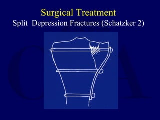 Surgical Treatment
Split Depression Fractures (Schatzker 2)
 