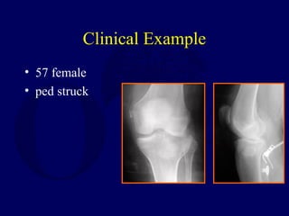 Clinical Example
• 57 female
• ped struck
 