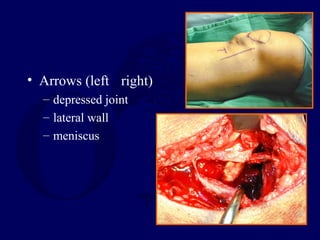 • Arrows (left right)
– depressed joint
– lateral wall
– meniscus
 