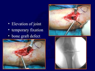 • Elevation of joint
• temporary fixation
• bone graft defect
 