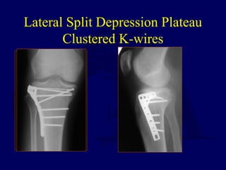 Lateral Split Depression Plateau
Clustered K-wires
 