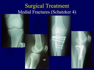 Surgical Treatment
Medial Fractures (Schatzker 4)
 