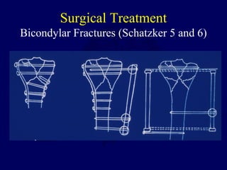 Surgical Treatment
Bicondylar Fractures (Schatzker 5 and 6)
 