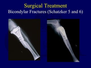 Surgical Treatment
Bicondylar Fractures (Schatzker 5 and 6)
 