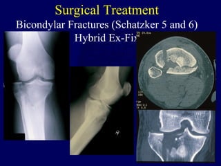Surgical Treatment
Bicondylar Fractures (Schatzker 5 and 6)
Hybrid Ex-Fix
 