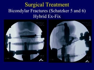 Surgical Treatment
Bicondylar Fractures (Schatzker 5 and 6)
Hybrid Ex-Fix
 