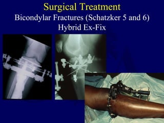 Surgical Treatment
Bicondylar Fractures (Schatzker 5 and 6)
Hybrid Ex-Fix
 