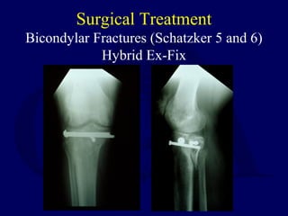 Surgical Treatment
Bicondylar Fractures (Schatzker 5 and 6)
Hybrid Ex-Fix
 