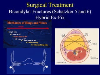 Surgical Treatment
Bicondylar Fractures (Schatzker 5 and 6)
Hybrid Ex-Fix
 