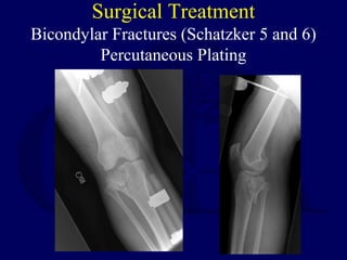 Surgical Treatment
Bicondylar Fractures (Schatzker 5 and 6)
Percutaneous Plating
 