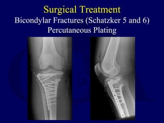 Surgical Treatment
Bicondylar Fractures (Schatzker 5 and 6)
Percutaneous Plating
 