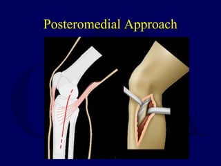 Posteromedial Approach
 