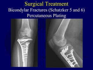 Surgical Treatment
Bicondylar Fractures (Schatzker 5 and 6)
Percutaneous Plating
 