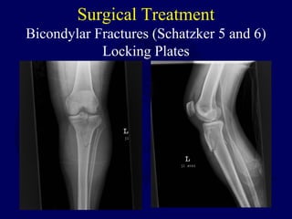 Surgical Treatment
Bicondylar Fractures (Schatzker 5 and 6)
Locking Plates
 