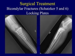 Surgical Treatment
Bicondylar Fractures (Schatzker 5 and 6)
Locking Plates
 