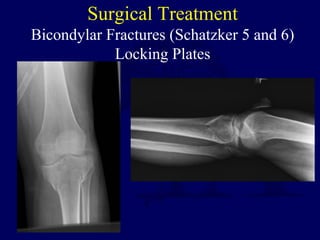 Surgical Treatment
Bicondylar Fractures (Schatzker 5 and 6)
Locking Plates
 