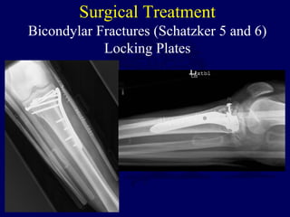 Surgical Treatment
Bicondylar Fractures (Schatzker 5 and 6)
Locking Plates
 