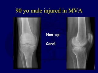 90 yo male injured in MVA
Non-op
Care!
 