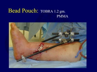 Bead Pouch: TOBRA 1.2 gm.
PMMA
 