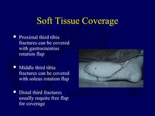 Soft Tissue Coverage
 Proximal third tibia
fractures can be covered
with gastrocnemius
rotation flap
 Middle third tibia
fractures can be covered
with soleus rotation flap
 Distal third fractures
usually require free flap
for coverage
 
