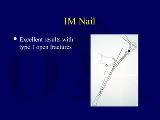 IM Nail
 Excellent results with
type 1 open fractures
 