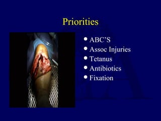Priorities
ABC’S
Assoc Injuries
Tetanus
Antibiotics
Fixation
 