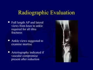 Radiographic Evaluation
 Full length AP and lateral
views from knee to ankle
required for all tibia
fractures
 Ankle views suggested to
examine mortise
 Arteriography indicated if
vascular compromise
present after reduction
 
