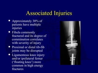 Associated Injuries
 Approximately 30% of
patients have multiple
injuries
 Fibula commonly
fractured and its degree of
comminution correlates
with severity of injury
 Proximal or distal tib-fib
joints may be disrupted
 Ligamentous knee injury
and/or ipsilateral femur
(‘floating knee’) more
common in high energy
fractures
 