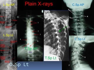 Plain X-rays
D.Sp Lt
L.Sp AP
L.Sp Lt
T.Sp Lt
T.Sp AP
C.Sp AP
C.Sp Lt
 