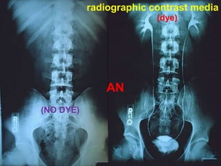 (dye)
radiographic contrast media
AN
(NO DYE)
 
