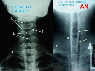 AN
C. SP AP NO
CONTRAST
C. SP AP With CONTRAST
in spinal canal
 