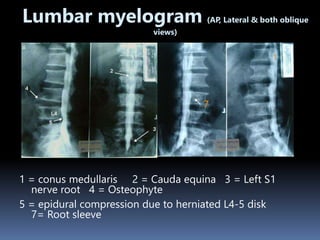 1
7
Lumbar myelogram (AP, Lateral & both oblique
views)
1 = conus medullaris 2 = Cauda equina 3 = Left S1
nerve root 4 = Osteophyte
5 = epidural compression due to herniated L4-5 disk
7= Root sleeve
 