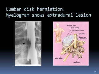 36
Lumbar disk herniation.
Myelogram shows extradural lesion
 