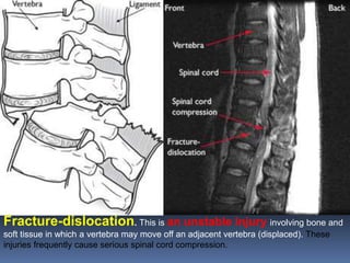 Fracture-dislocation. This is an unstable injury involving bone and
soft tissue in which a vertebra may move off an adjacent vertebra (displaced). These
injuries frequently cause serious spinal cord compression.
 