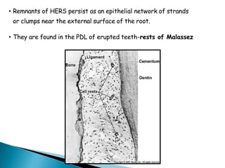 • Remnants of HERS persist as an epithelial network of strands
or clumps near the external surface of the root.
• They are found in the PDL of erupted teeth-rests of Malassez
 