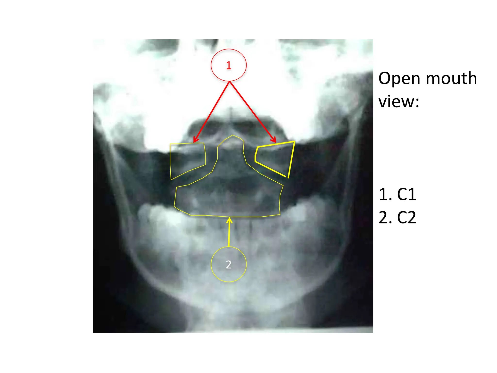 L1-vertebra Radiological -Anatomy. pptt | PPT